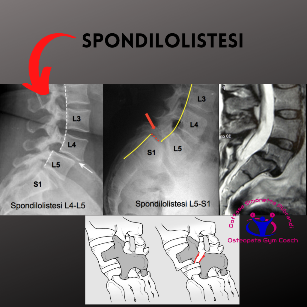 simonetta alibrandi osteopata roma personal trainer mezieres nervo sciatico spondilolistesi sciatalgia esercizi rimedi