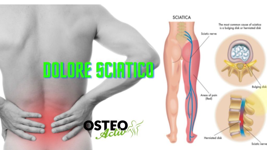lombosciatalgia e sciatalgia