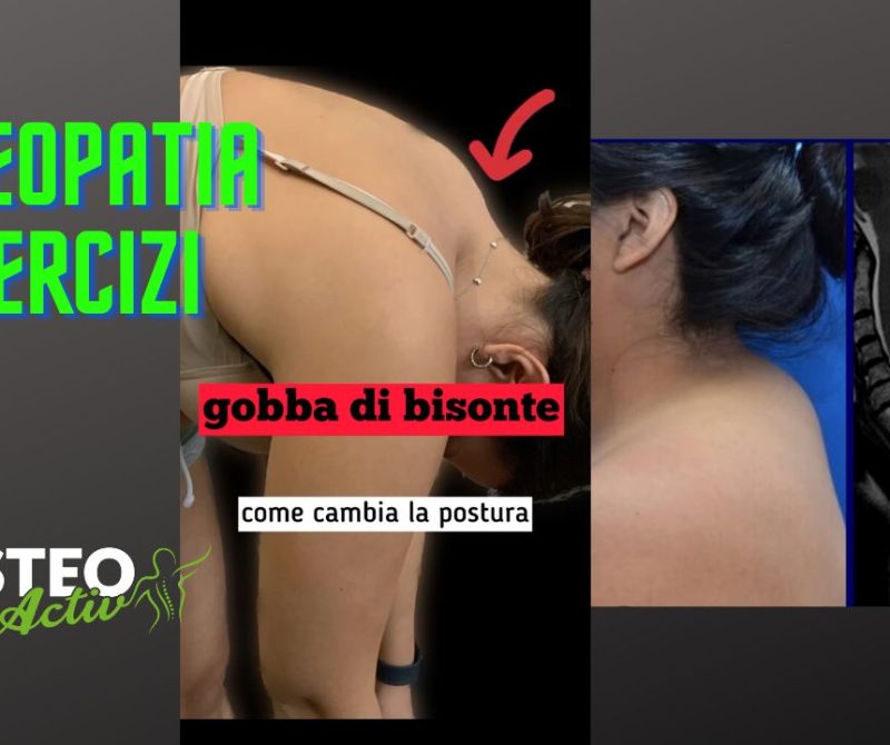 Gobba del bisonte lipodistrofia cervi o-dorsale