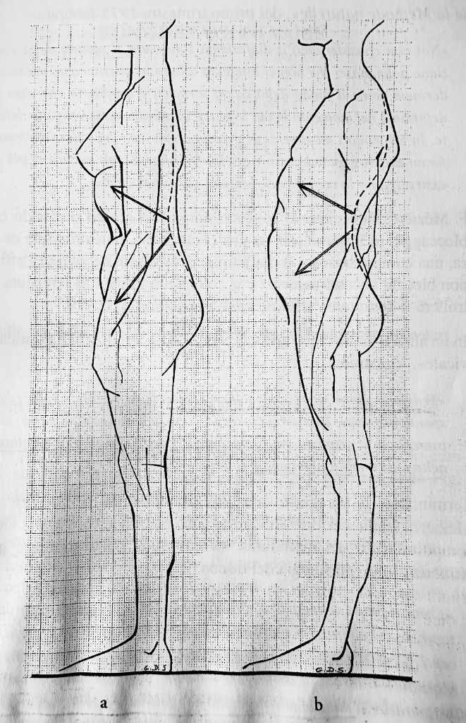 Lordosi diaframmatica associata al muscolo psoas