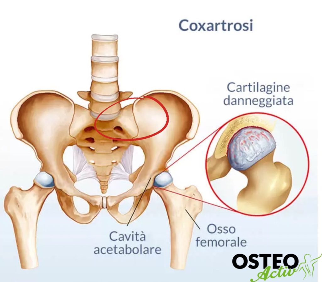 coxartrosi