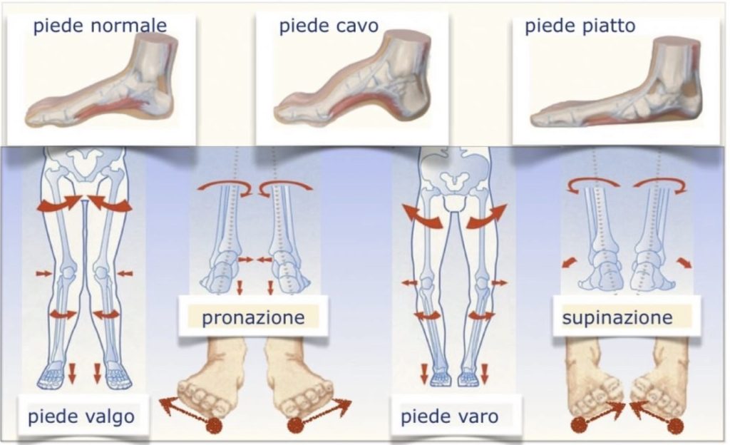 vari tipi di piedi piatti valghi cavi